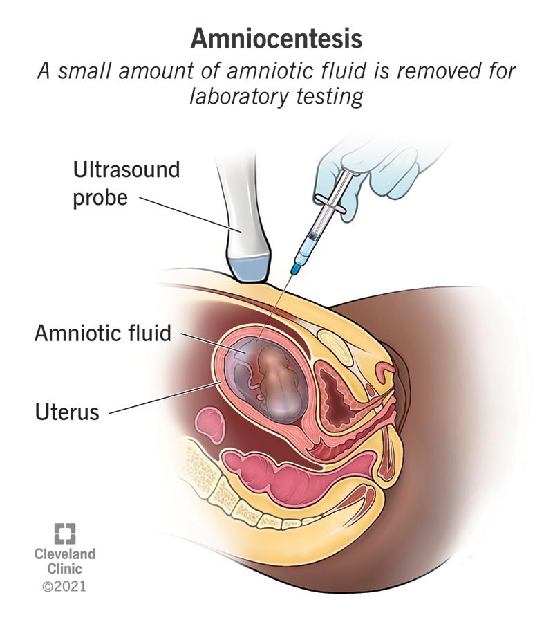 4206-genetic-amniocentesis